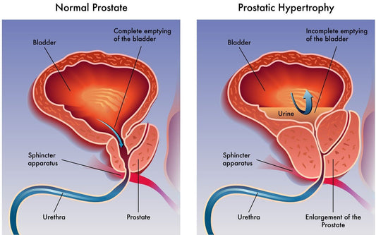 The Advanced Research Perspective on Benign Prostatic Hyperplasia (BPH) and the Urgent Need for Effective Solutions